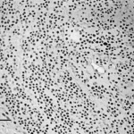 Immagine al microscopio elettronico di un glomerulo renale affetto da Nefropatia da IgA, con depositi elettrondensi visibili nell'area mesangiale. Obiettivo macro ad alta risoluzione (es. 100mm), illuminazione specifica per microscopia elettronica, dettagli ultrastrutturali del danno tissutale, bianco e nero con contrasto elevato.