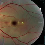 Immagine dettagliata di una scansione OCT della retina che mostra segni di retinopatia diabetica, sovrapposta a un'interfaccia grafica di intelligenza artificiale che evidenzia le anomalie. Macro lens, 100mm, high detail, precise focusing, controlled lighting, visualizzazione dati medici.
