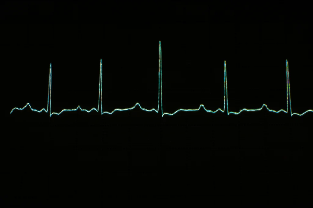 Immagine macro di un tracciato elettrocardiografico che mostra chiaramente il passaggio da un ritmo sinusale regolare a una fibrillazione atriale caotica. Luce laterale drammatica per evidenziare le onde F irregolari, lente macro 100mm, alta definizione, sfondo scuro.