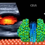 Immagine fotorealistica concettuale che unisce un'immagine ecografica con contrasto (CEUS) di un nodulo tiroideo papillare e una rappresentazione 3D della molecola EpCAM sulla superficie di cellule tumorali. Metà immagine mostra lo schermo di un ecografo con un nodulo ipoecogeno e ipervascolarizzato alla CEUS, l'altra metà visualizza la struttura proteica di EpCAM integrata nella membrana cellulare. Obiettivo 50mm, illuminazione suggestiva che collega visivamente le due metà, focus nitido su entrambi gli aspetti (imaging e molecolare).