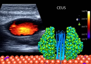 Immagine fotorealistica concettuale che unisce un'immagine ecografica con contrasto (CEUS) di un nodulo tiroideo papillare e una rappresentazione 3D della molecola EpCAM sulla superficie di cellule tumorali. Metà immagine mostra lo schermo di un ecografo con un nodulo ipoecogeno e ipervascolarizzato alla CEUS, l'altra metà visualizza la struttura proteica di EpCAM integrata nella membrana cellulare. Obiettivo 50mm, illuminazione suggestiva che collega visivamente le due metà, focus nitido su entrambi gli aspetti (imaging e molecolare).