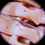 Immagine medica ad alta definizione che mostra una sezione trasversale di una vertebra toracica con un ago per vertebroplastica inserito tramite l'approccio UTPPA, evidenziando la precisione richiesta. Macro lens, 100mm, illuminazione da studio, focus preciso sulla punta dell'ago e sulla struttura ossea.