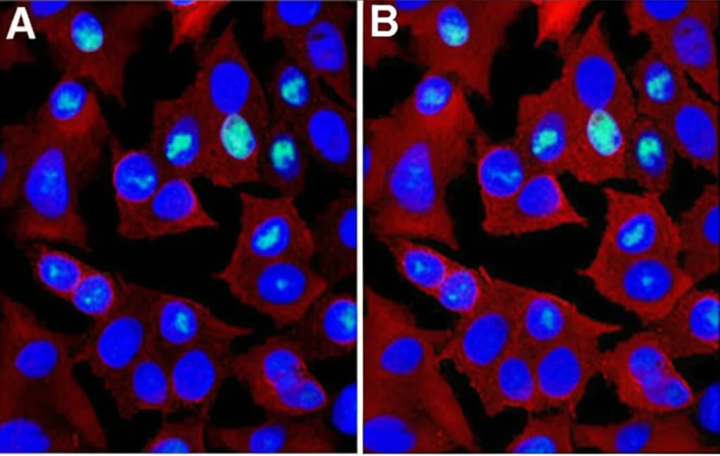 Immagine fotorealistica al microscopio a fluorescenza di cellule tumorali polmonari (NSCLC) trattate con SM-3. Si vedono nuclei frammentati (blu, colorazione Hoechst) e cellule in apoptosi/necrosi (rosso/rosa, colorazione PI), indicando morte cellulare indotta dal composto. Obiettivo 20x, illuminazione controllata.