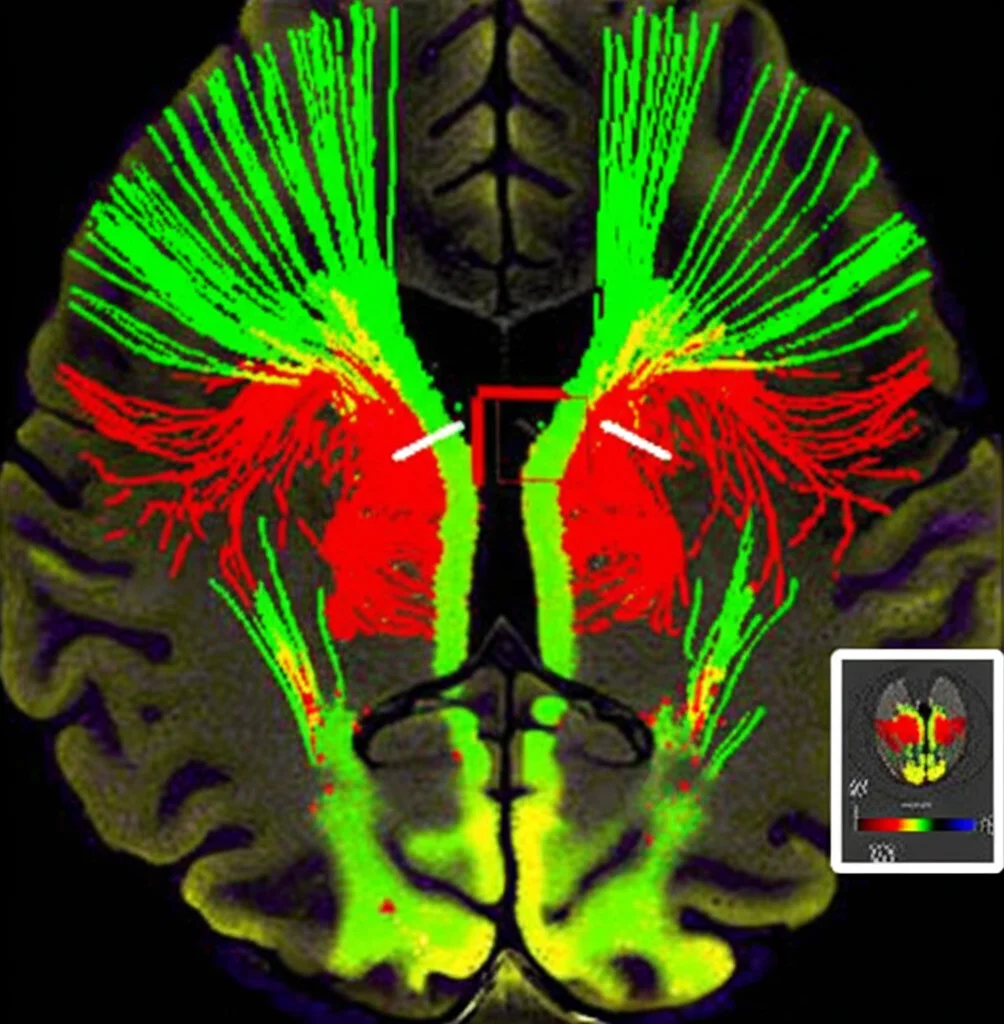 Mappa a colori DTI del cervello a livello dei ventricoli laterali, che mostra i tratti di fibre di proiezione (verde) e associazione (rosso), con un piccolo cubo ROI posizionato per misurare la diffusività, visualizzazione scientifica, high detail, colori vividi.