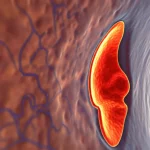 Immagine medica avanzata VWI che mostra in dettaglio le arterie vertebrobasilari nel cervello umano, evidenziando una placca aterosclerotica ad alto rischio sulla parete del vaso. Visualizzazione 3D ad alta risoluzione, prime lens 35mm, depth of field, illuminazione controllata per dettagli scientifici.