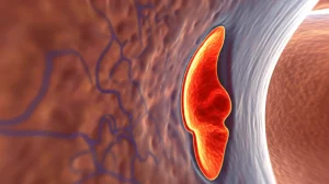 Immagine medica avanzata VWI che mostra in dettaglio le arterie vertebrobasilari nel cervello umano, evidenziando una placca aterosclerotica ad alto rischio sulla parete del vaso. Visualizzazione 3D ad alta risoluzione, prime lens 35mm, depth of field, illuminazione controllata per dettagli scientifici.