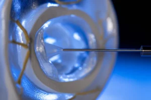 Fotografia macro ad alta definizione di un ago chirurgico sottile posizionato con precisione vicino a un modello trasparente del nervo trigemino e del forame ovale. Illuminazione da studio controllata per enfatizzare la precisione. Obiettivo macro 100mm.