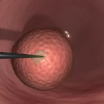 Immagine macro di un endoscopio utilizzato per una TURBT che si avvicina a un tumore papillare all'interno di una vescica umana stilizzata digitalmente. Illuminazione controllata, alta definizione, obiettivo macro 100mm, focus preciso sul tumore e sulla punta dello strumento.