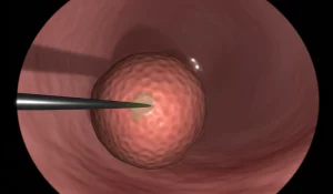 Immagine macro di un endoscopio utilizzato per una TURBT che si avvicina a un tumore papillare all'interno di una vescica umana stilizzata digitalmente. Illuminazione controllata, alta definizione, obiettivo macro 100mm, focus preciso sul tumore e sulla punta dello strumento.