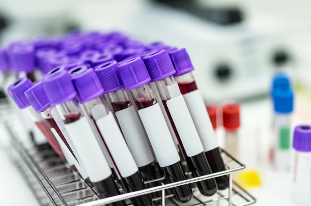 Primo piano di una provetta di sangue etichettata in un rack all'interno di un laboratorio di analisi mediche. Macro lens 100mm, high detail, illuminazione controllata e precisa per evidenziare l'etichetta e il campione di sangue, sfondo leggermente sfocato con altre attrezzature da laboratorio.