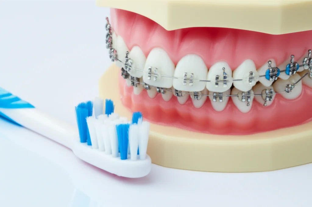 Fotografia macro di uno spazzolino da denti con setole pulite vicino a un modello di denti con apparecchio ortodontico fisso, illuminazione da studio controllata per evidenziare i dettagli, obiettivo macro 100mm, alta definizione.