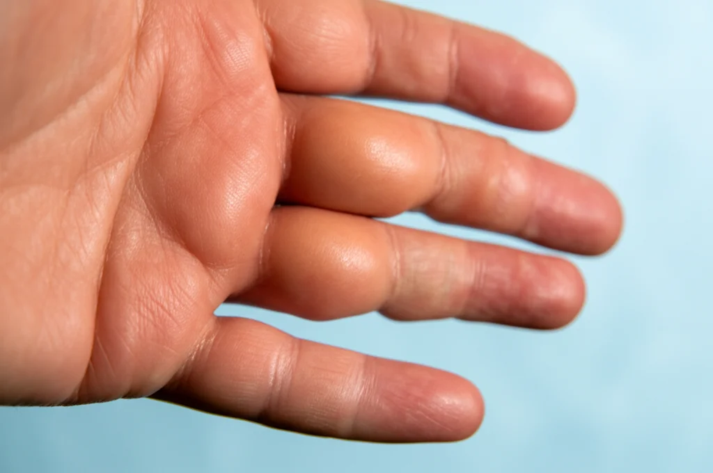 Primo piano di una mano con articolazioni leggermente gonfie tipiche dell'artrite reumatoide, obiettivo macro 100mm, alta definizione, illuminazione controllata per evidenziare la texture della pelle e i segni dell'infiammazione.