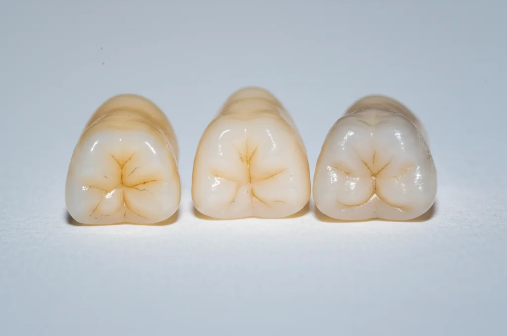 Fotografia macro (obiettivo 100mm) di tre molari artificiali per protesi dentaria (PMMA) affiancati su un banco da laboratorio dentistico illuminato professionalmente. Un dente è di tipo convenzionale (aspetto leggermente più opaco), uno fresato da blocco PMMA (superficie liscia e compatta), uno stampato in 3D con resina specifica (si notano leggermente le linee di stratificazione). Alta definizione, focus preciso sulle diverse texture superficiali, controlled lighting.
