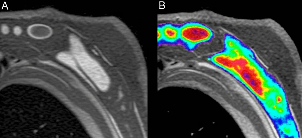 Confronto affiancato di due immagini di risonanza magnetica cardiaca in sezione trasversale. A sinistra, l'immagine cine standard del miocardio. A destra, la stessa immagine con sovrapposta una mappa parametrica colorata che evidenzia le variazioni quantitative di una feature radiomica nel tessuto. Macro lens, 80mm, high detail, precise focusing, visualizzazione dati.