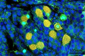 Visualizzazione microscopica ad alta risoluzione di cellule T CD8+ (gialle, luminose) che infiltrano attivamente un tumore gastrico (cellule più grandi, ciano), con alcune cellule T che esprimono chiaramente il marcatore T-bet (nucleo verde). L'immagine suggerisce interazione e attività immunitaria nel microambiente tumorale. Obiettivo macro 100mm, illuminazione controllata per fluorescenza, alta definizione, dettagli cellulari precisi.