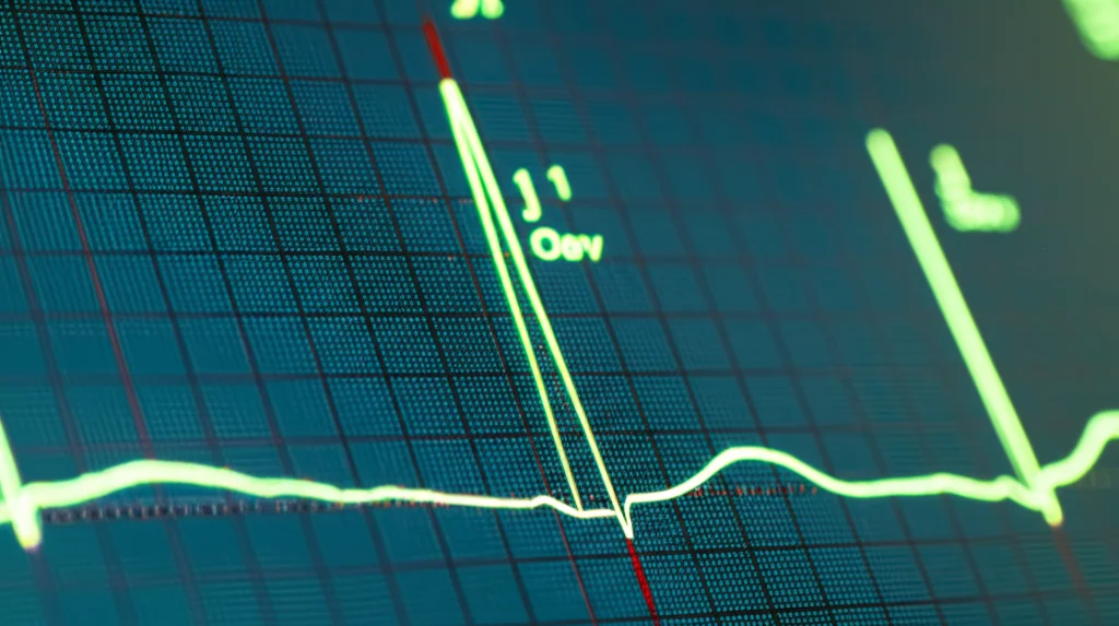 Primo piano di un tracciato ECG su uno schermo digitale, macro lens, 80mm, alta definizione, illuminazione controllata, che mostra chiaramente un'onda J ischemica e altre alterazioni tipiche dell'infarto precoce.