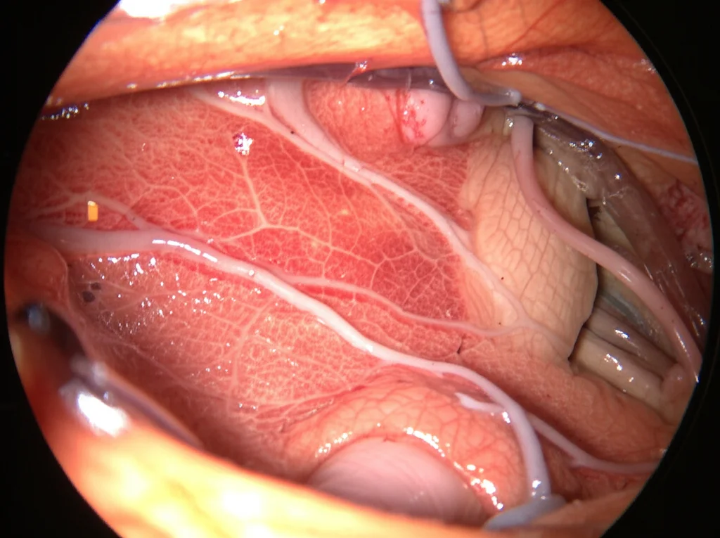 Vista intraoperatoria fotorealistica attraverso un esoscopio 3D che mostra la scissura interemisferica del cervello. Si vedono chiaramente la falce cerebrale e alcune vene a ponte. Luce chirurgica intensa, macro lens, 100mm, alta definizione, messa a fuoco precisa sulle strutture neurali.