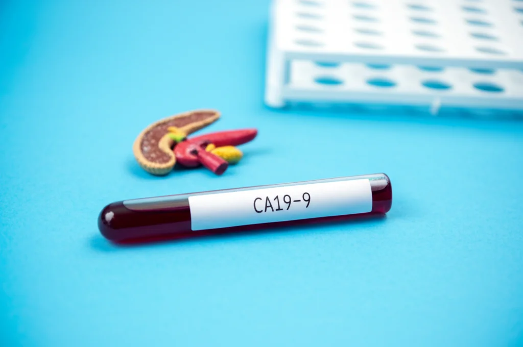 Immagine macro di una provetta di sangue con etichetta CA19-9 accanto a un modello anatomico del pancreas e del dotto biliare, illuminazione controllata e alta definizione per enfatizzare la complessità diagnostica e il legame con la colestasi. Obiettivo macro 60mm.