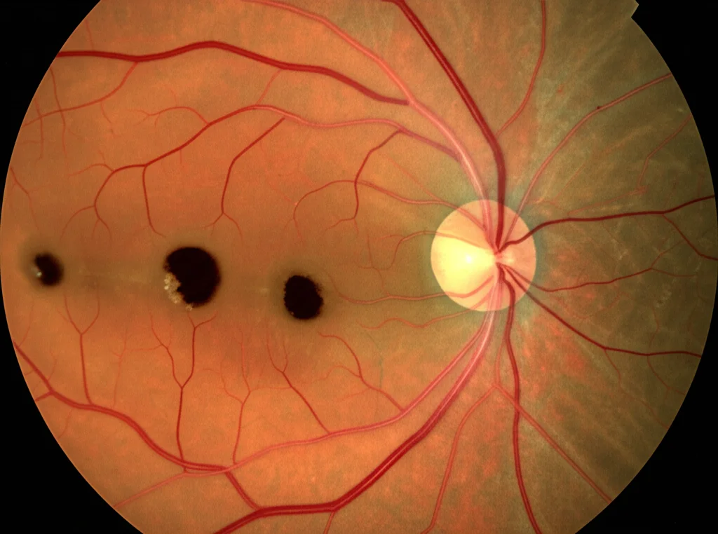 Immagine OCT (Tomografia a Coerenza Ottica) della retina umana che mostra chiaramente un edema maculare diabetico cistoide refrattario, con grandi cisti scure piene di liquido negli strati retinici, alta definizione, illuminazione da strumento medico, obiettivo macro 60mm.