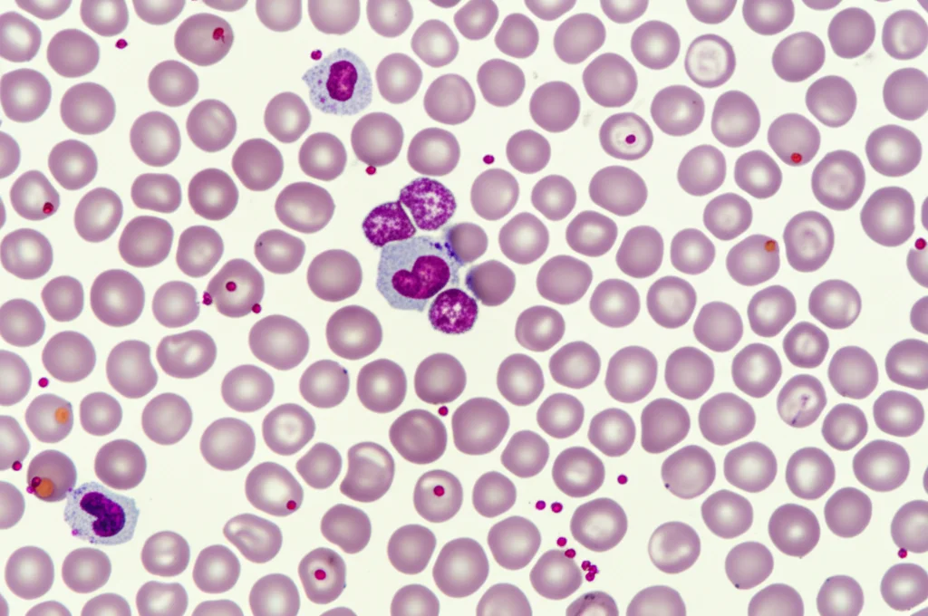 Immagine macro di cellule del sangue in una provetta o su un vetrino da microscopio, con alcune cellule evidenziate o alterate. Illuminazione controllata da laboratorio, obiettivo macro 100mm, alta definizione dei dettagli cellulari.
