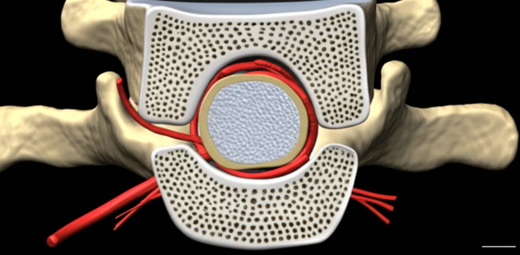 Lenti macro, 85 mm, dettagli elevati, messa a fuoco precisa, illuminazione controllata, che mostra un modello 3D dettagliato che confronta una sezione trasversale sana del canale spinale lombare con uno che mostra una grave stenosi centrale (Schiza Grade C/D), evidenziando le radici del sacca tecale e nervosa compressa.