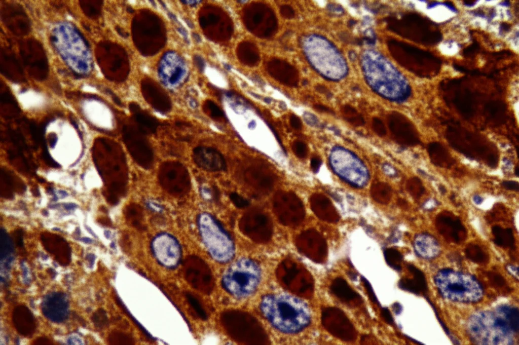 Immagine al microscopio ad alta risoluzione di cellule di carcinoma renale papillare di tipo 2, evidenziando la proteina TPX2 tramite colorazione immunoistochimica marrone scuro nel citosol e nei nuclei durante la mitosi, lente macro 100mm, illuminazione controllata, dettagli cellulari precisi.