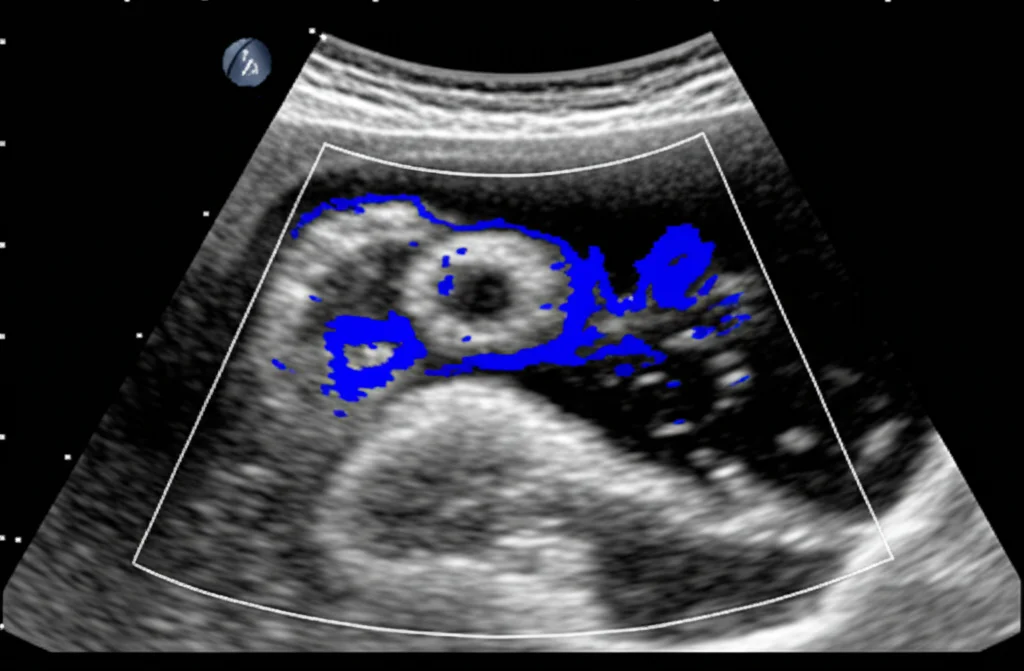 Immagine ecografica del seno che mostra un nodulo ipoecogeno ben definito con vascolarizzazione accentuata, indicativo di metastasi. Obiettivo macro 80mm, illuminazione controllata, alta definizione.