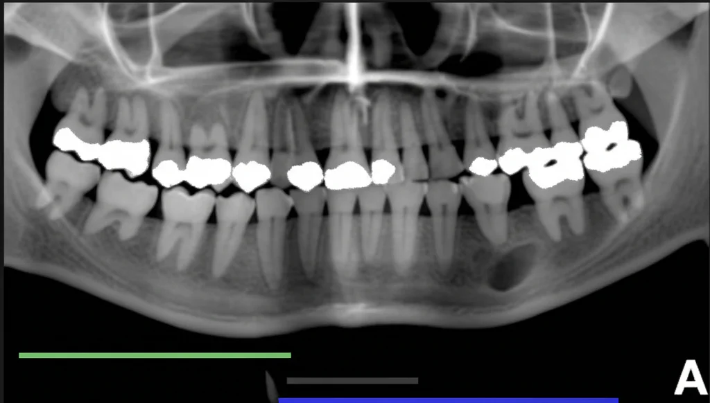 Immagine radiografica CBCT sezione trasversale che mostra chiaramente lo spessore gengivale e osseo vestibolare di un incisivo superiore, alta risoluzione, focus nitido, visualizzazione tecnica per odontoiatria.