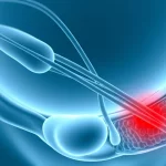 Illustrazione medica stilizzata che mostra uno sling mid-uretrale posizionato sotto l'uretra femminile, con un'area evidenziata in rosso che indica l'erosione del tessuto uretrale, sfondo medico pulito, illuminazione da studio.
