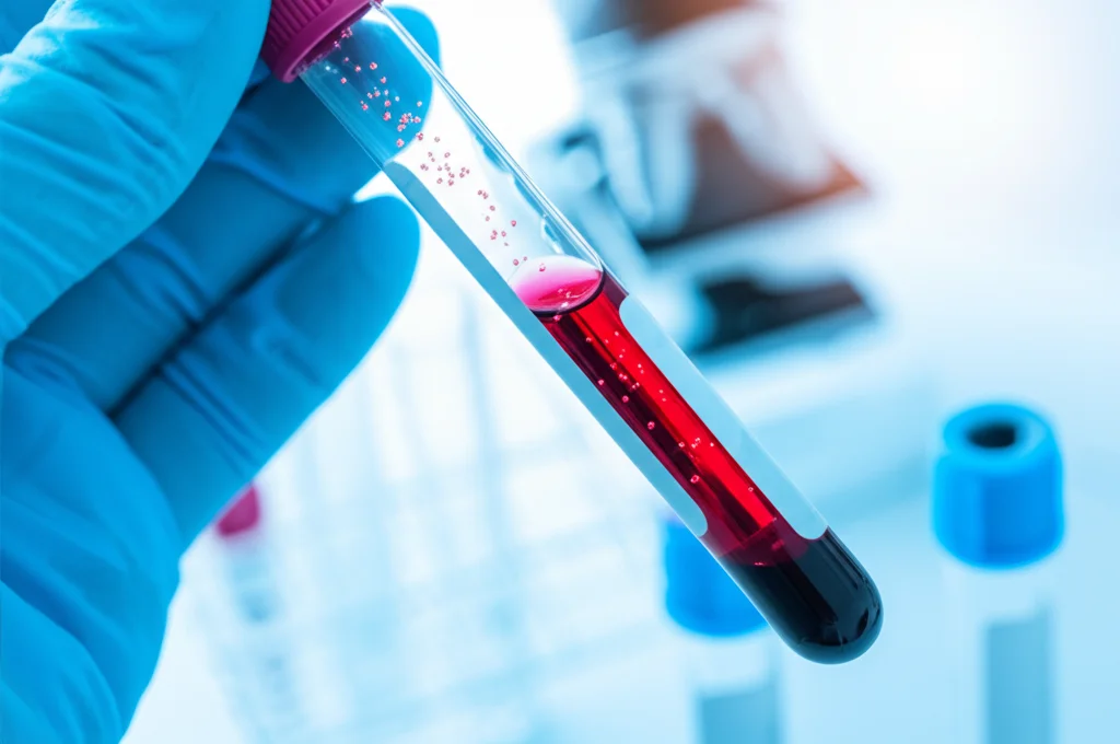 Scatto macro con lente da 60mm, alta definizione e illuminazione controllata, che visualizza particelle molecolari astratte la cui concentrazione cambia all'interno di una provetta di campione di sangue tenuta da una mano guantata in un laboratorio clinico, rappresentando il monitoraggio tramite biopsia liquida.