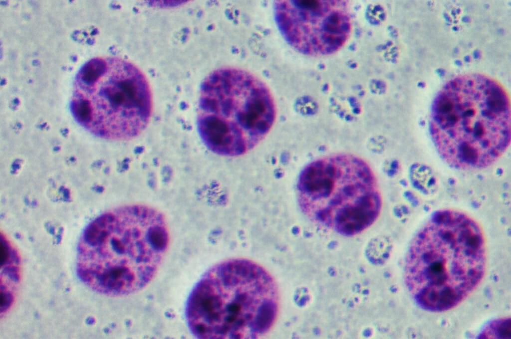 Micrografia ad alta risoluzione di cellule tumorali MCF-7 in coltura, alcune delle quali mostrano segni di apoptosi dopo trattamento farmacologico. Illuminazione da laboratorio controllata, obiettivo macro 100mm, high detail, messa a fuoco precisa sui cambiamenti morfologici cellulari.