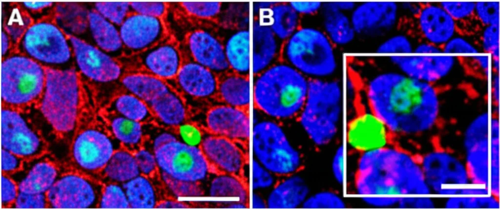 Microscopia a fluorescenza ad alta risoluzione che mostra cellule NK (rosse, marcatore CD56) infiltranti un tessuto di cancro esofageo (nuclei blu, DAPI). Alcune cellule NK esprimono la proteina SAMD3 (verde), evidenziate in un riquadro ingrandito. Obiettivo macro 100mm, alta definizione, illuminazione controllata.