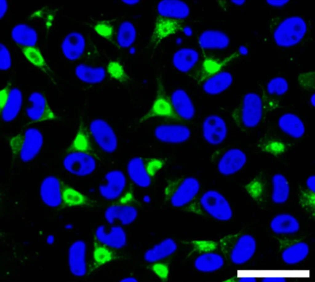 Microscopia confocale di cellule leucemiche linfoidi umane (ALL), obiettivo macro 100mm, alta definizione, illuminazione controllata, che mostra il nucleo colorato di blu (TO-PRO-3) e foci luminosi verdi indicanti la proteina p-RPA legata a tratti di DNA a singolo filamento, segno di stress replicativo.