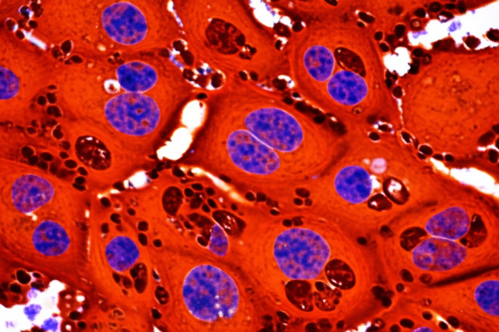 Immagine macro ad alta definizione di cellule tumorali al seno al microscopio, alcune delle quali mostrano segni di stress o morte cellulare (frammentazione, alterazioni morfologiche). Illuminazione controllata per evidenziare dettagli cellulari. Focus preciso sulle strutture interne. Lente macro 90mm.