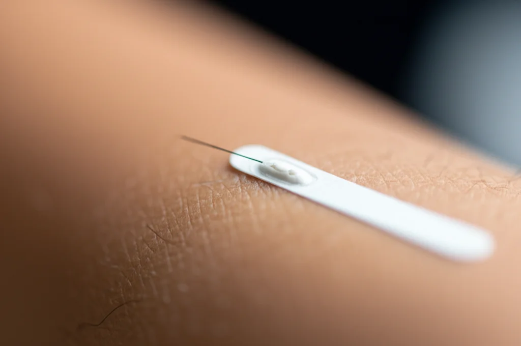 Fotografia macro di un sensore CGM applicato sul braccio di una persona, messa a fuoco precisa sul piccolo filamento sotto la pelle, illuminazione controllata per evidenziare i dettagli tecnologici, obiettivo macro 90mm.