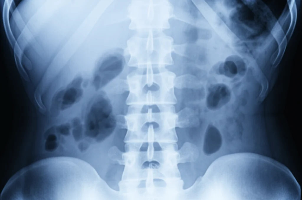 Radiografia della colonna vertebrale che mostra una deformità spinale adulta (scoliosi e cifosi), immagine medica ad alta definizione, illuminazione controllata, lente macro 90mm per dettaglio osseo.