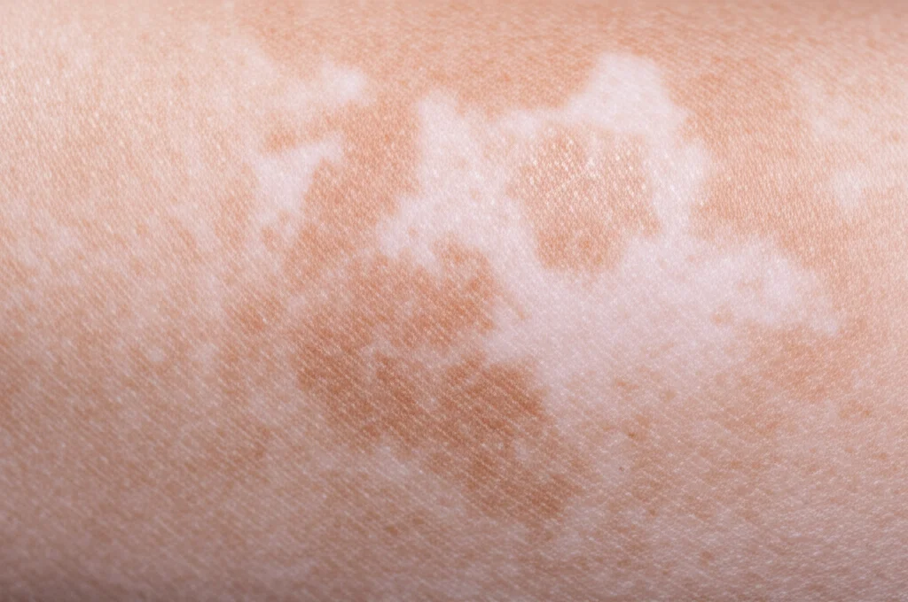 Fotografia macro di pelle con chiazze di vitiligine, mettendo a fuoco il contrasto tra pelle pigmentata e depigmentata, illuminazione da studio controllata per massimizzare i dettagli della texture, obiettivo macro 100mm, alta definizione.