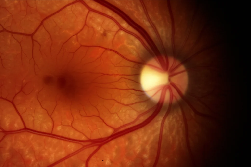 Primo piano macro di un occhio umano che mostra i vasi sanguigni della retina, alcuni dei quali presentano microaneurismi indicativi di retinopatia diabetica iniziale. Illuminazione controllata, lente macro 90mm, alta definizione.