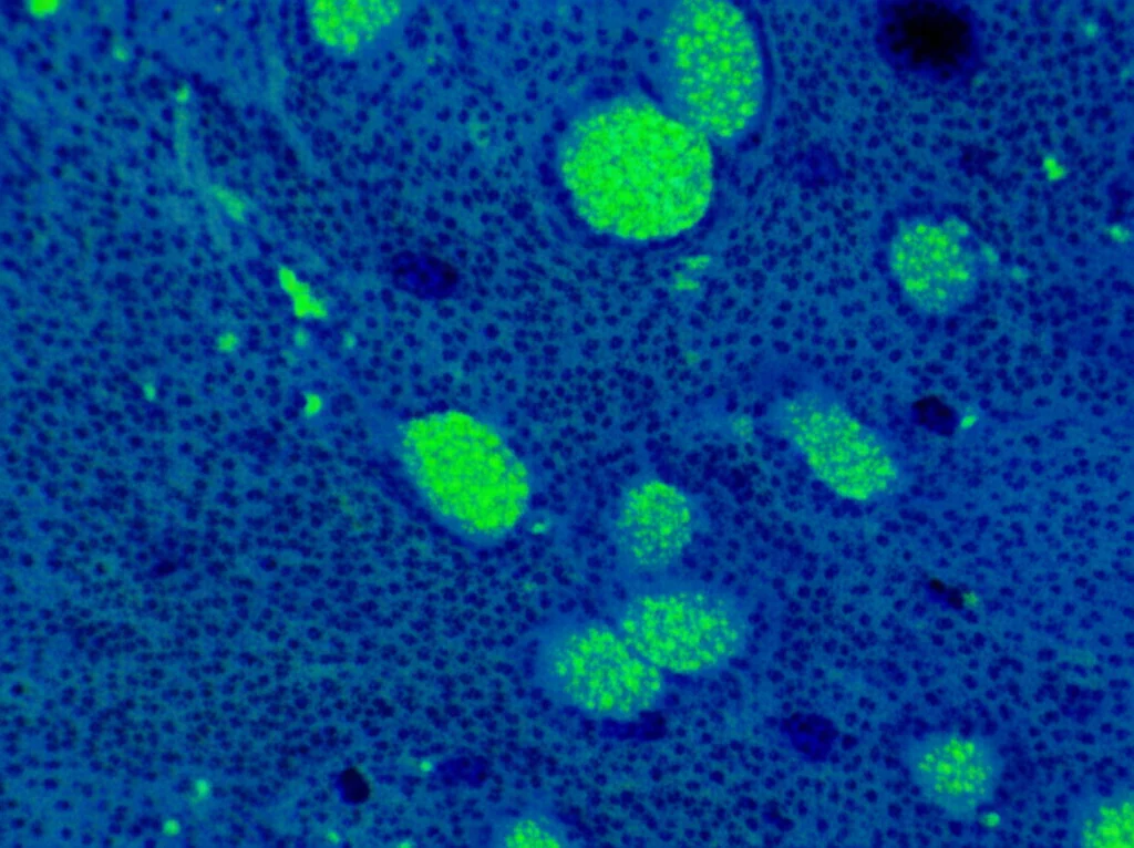 Immagine macro ad alta definizione di una sezione di tessuto cerebrale di medulloblastoma SHH al microscopio, illuminazione controllata, con focus preciso sulle cellule tumorali che mostrano un'elevata espressione della proteina Eftud2 evidenziata con fluorescenza verde brillante, obiettivo macro 100mm.
