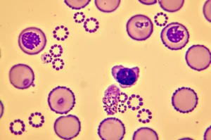 Fotografia macro, 100mm, alta definizione, messa a fuoco precisa, illuminazione controllata, che mostra una goccia di sangue su un vetrino da microscopio con piastrine e cellule visibili in dettaglio, simboleggiando l'analisi del sangue per il biomarker PHR.