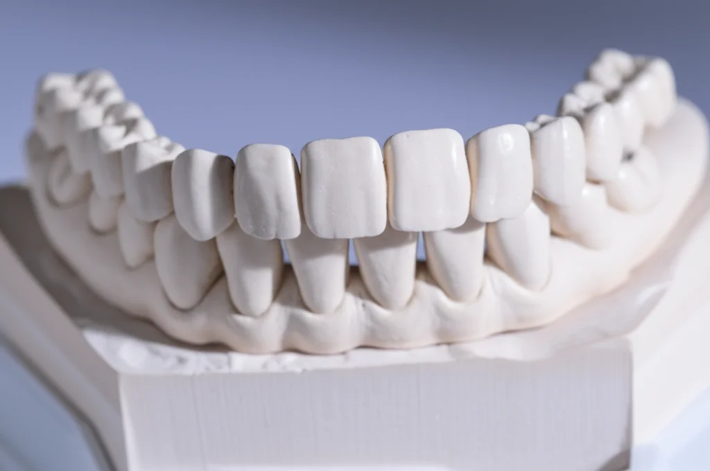 Still life object photography, macro lens 60mm, scatto ad alto dettaglio di modelli dentali in gesso che mostrano diversi pattern di occlusione basati sul contatto dei denti posteriori, messa a fuoco precisa sotto una brillante luce da studio dentistico.