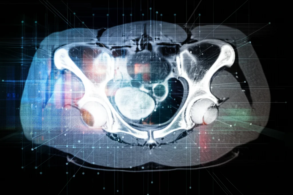Immagine medica astratta che mostra strati di dati digitali luminosi sovrapposti a una scansione MRI della pelvi, simboleggiando l'estrazione di feature radiomiche. Illuminazione controllata, obiettivo macro 90mm per dettaglio elevato, high detail.