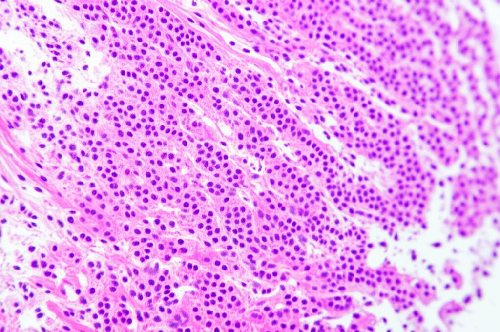 Immagine macro ad alta definizione di linfonodi umani su un vetrino da microscopio, illuminazione controllata per evidenziare le strutture cellulari, obiettivo macro 100mm, messa a fuoco precisa sulle aree potenzialmente metastatiche.