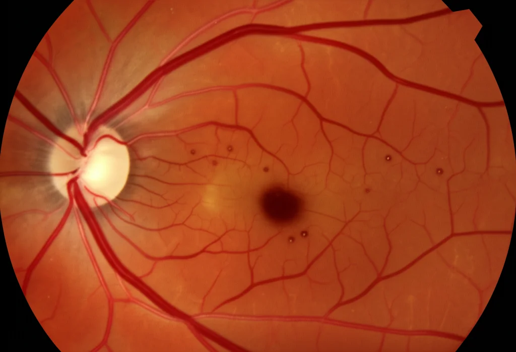 Immagine macro fotorealistica di una retina umana con segni precoci di retinopatia diabetica non proliferativa, come microaneurismi e piccole emorragie puntiformi. Obiettivo macro 60mm, alta definizione, focus preciso, illuminazione controllata per evidenziare i dettagli vascolari.