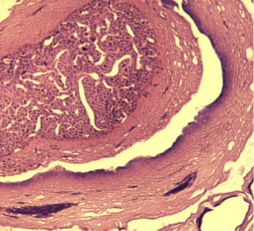 Sezione trasversale di un'arteria carotide di ratto visualizzata al microscopio dopo un danno sperimentale (balloon injury). Si notano l'ispessimento della parete interna (iperplasia intimale) e il restringimento del lume. Obiettivo macro 100mm, colorazione Ematossilina-Eosina, alta definizione, illuminazione controllata da laboratorio, messa a fuoco precisa sull'area della lesione.