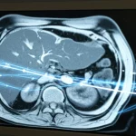 Immagine fotorealistica ad alto dettaglio di una scansione MRI del fegato visualizzata su un monitor medicale avanzato, con sovrapposte linee luminose astratte che rappresentano le connessioni di una rete neurale (AI). Utilizzare un obiettivo macro da 85mm per mettere a fuoco i dettagli della scansione e le linee AI, con illuminazione controllata per enfatizzare l'aspetto tecnologico e diagnostico. High detail, precise focusing, controlled lighting, medical technology, artificial intelligence analysis.