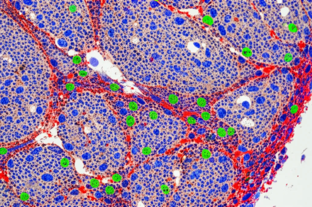 Microscopia ad alta risoluzione del microambiente tumorale del fegato, che mostra cellule tumorali (grigio scuro) infiltrate da diverse cellule immunitarie (colori vivaci come blu, verde, rosso) nel gruppo a basso rischio CRGRM. Prime lens, 35mm, depth of field, illuminazione drammatica che evidenzia l'interazione cellulare.