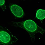 Illustrazione scientifica fotorealistica che mostra tessuto endometriosico ectopico con cellule che esprimono alti livelli della proteina PYK2 (visualizzata con fluorescenza verde brillante), evidenziando la morfologia invasiva e la transizione epitelio-mesenchimale in corso, obiettivo macro 85mm, alta definizione dei dettagli cellulari, illuminazione drammatica con sfondo scuro per enfatizzare la fluorescenza.