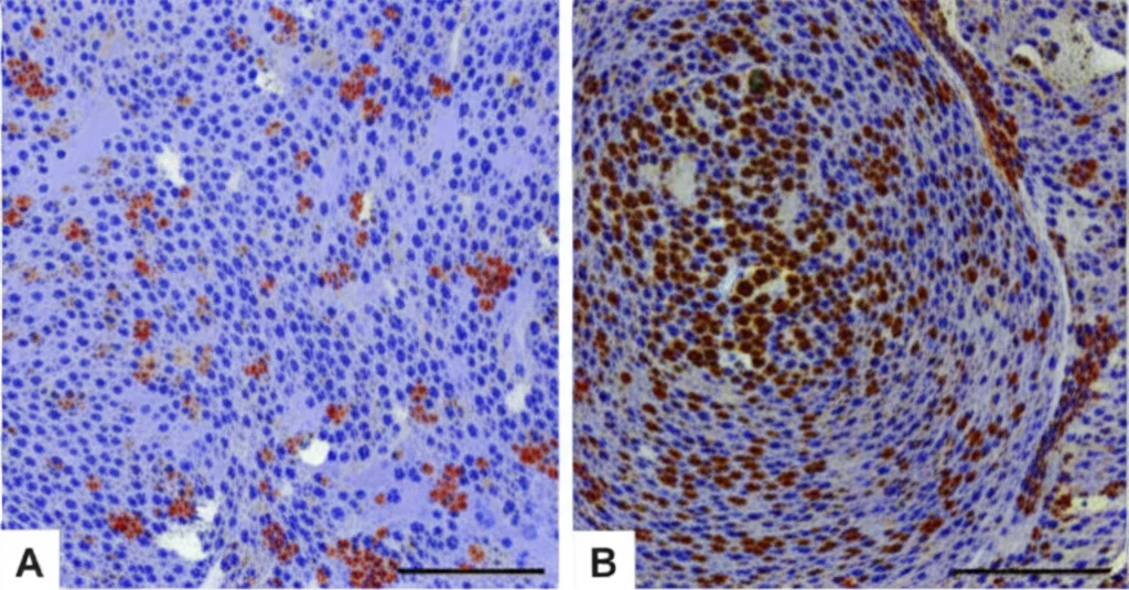 Visualizzazione immunoistochimica del microambiente tumorale HNSCC. Immagine ad alta definizione con obiettivo macro 60mm, mostra l'infiltrazione di linfociti T CD8+ (marroni, scarsi) e macrofagi M2 (rossi, abbondanti) tra le cellule tumorali (blu/viola). Colorazione specifica, focus preciso sulle diverse popolazioni cellulari.