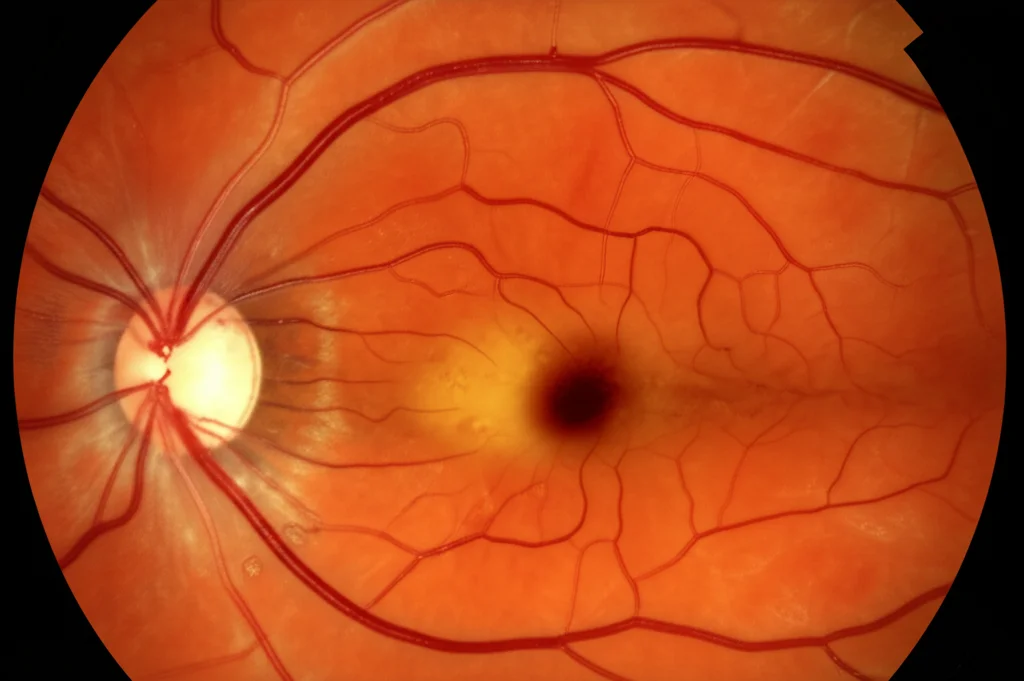 Close-up macro fotografia di una retina umana che mostra i primi segni di retinopatia diabetica, come microaneurysmi e piccoli vasi sanguigni danneggiati. Lente macro 80mm, alta definizione, messa a fuoco precisa, illuminazione clinica controllata.